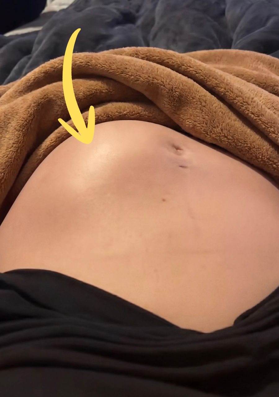 Close-up of a swollen, hard tummy caused by a fibroid
