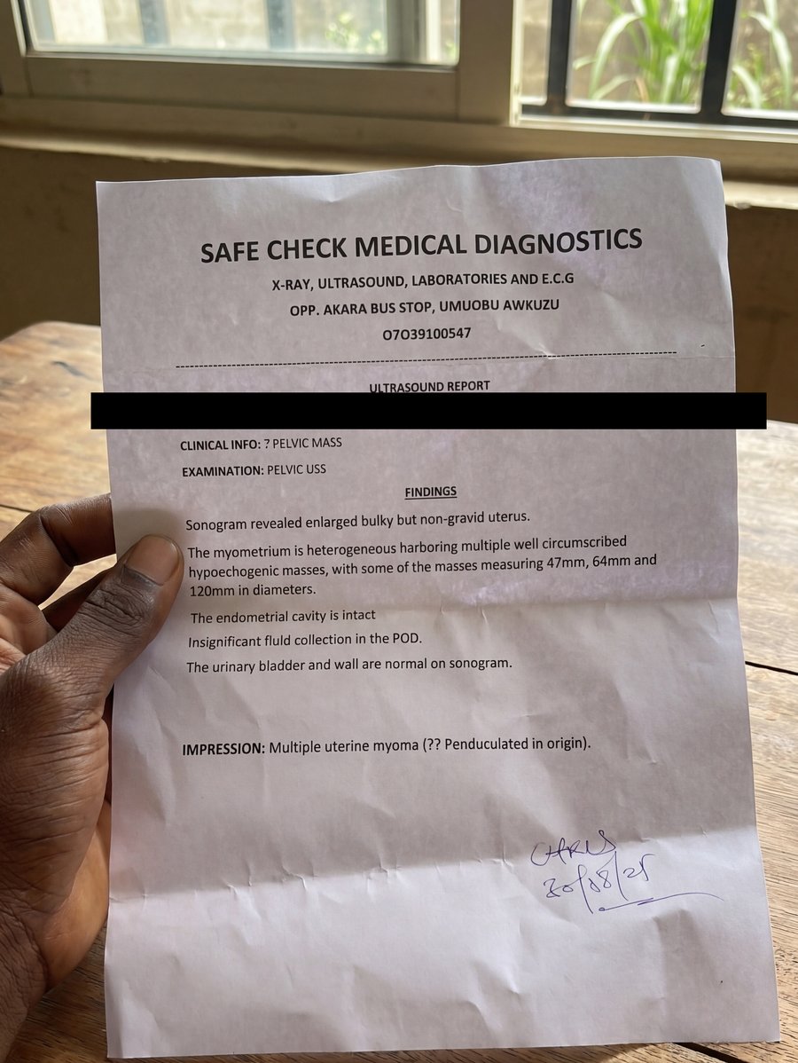 Ultrasound scan report showing multiple fibroid masses (patient name redacted for privacy)